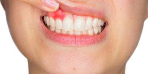 the image of bad gum trauma