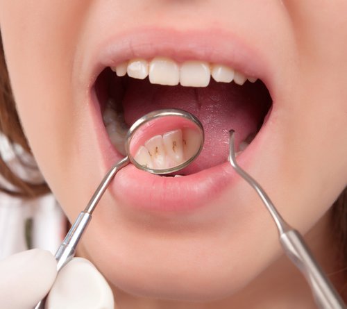 women with hollow teeth