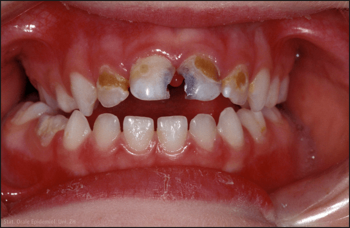 Read more about the article Gangren Pulpa